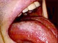 Bệnh nhân nhiễm HIV dễ có cơ hội nhiễm nấm Penicillium marneffei gây bệnh