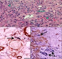 Nhiễm sán lá gan lớn gây ứ tắc mật ngoài gan-ca bệnh hiếm gặp trong thực hành lâm sàng tiêu hóa trên thế giới