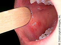 Những thông tin cập nhật mới nhất về bệnh tay-chân-miệng