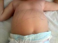 Ca bệnh giun đũa chó trên một trẻ tập đi có tăng bạch cầu ái toan bất thường