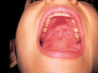 Bệnh tay chân miệng không ngừng diễn biến phức tạp