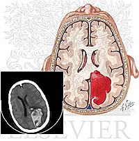Phát hiện một số ca bệnh giun sán đặc biệt ở người 