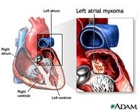 U tim (Cardiac Tumors) – một bệnh lý rất nguy hiểm nhưng chưa được quan tâm đúng mức
