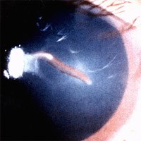 Bệnh giun đầu gai thể thần kinh-bệnh lý do căn bệnh ký sinh trùng đang bị lãng quên