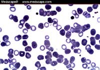 Phân biệt nhiều bệnh truyền nhiễm nguy hiểm qua phân tích kết quả tiêu bản máu nhuộm giem sa hoặc Wright 