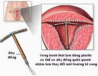 Phòng tránh thai bằng dụng cụ tử cung