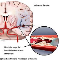 Gia tăng đột quỵ ở trẻ em- một vấn đề y tế cần quan tâm