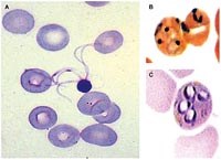 Sốt rét ác tính đa phủ tạng gây nguy cơ tử vong cao