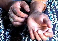 Điểm báo về các thông tin liên quan đến y tế ngày 15/9 & 16/9 năm 2011