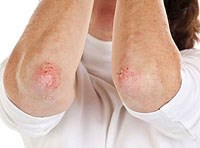 Xử trí tổn thương phần mềm