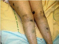 Vết bầm máu hoặc quầng máu dưới da-một triệu chứng không nên coi thường