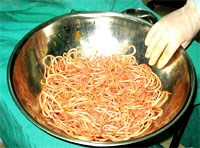 Lấy hơn 300 con giun từ bụng bệnh nhi