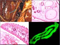 Tổng hợp y văn nhân một trường hợp tổn thương đa cơ quan do sán lá gan lớn Fasciola gigantica 