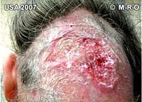 Một trong những hội chứng liên quan đến bệnh ký sinh trùng đang được tranh luận đa ngành nhiều nhất (Morgellon’s syndrome)