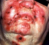 Một số hội chứng bệnh ký sinh trùng nguy hiểm hiếm gặp