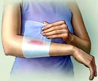 Phòng tránh thảm họa bỏng do tai nạn, thương tích