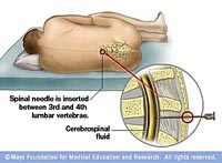 Chọc dò và phân tích dịch não tủy-một trong những thủ thuật và xét nghiệm quan trọng trong chẩn đoán bệnh truyền nhiễm