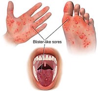 Bệnh tay chân miệng chưa có hồi kết