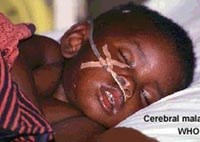 Phân biệt sốt rét ác tính thể não với một số bệnh thường gặp