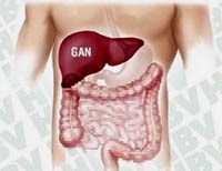 Gan to, viêm gan và xơ gan do bệnh sốt rét