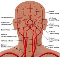 Biến chứng nguy hiểm từ bệnh cảnh lâm sàng dễ bỏ sót thiểu năng hoặc rối loạn tuần hoàn não