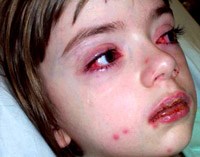 Phản ứng của cơ thể do dị ứng thuốc