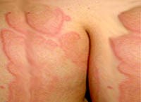 Xử trí nổi mề đay do dị ứng thuốc