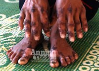 Điểm báo về các thông tin liên quan đến y  tế từ ngày 13/1 đến 15/1 năm 2012