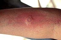 Cập nhật thông tin về sinh lý bệnh và điều trị ca bệnh ấu trùng giun đầu gai Gnathostoma spinigerum