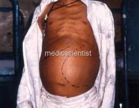 Sốt rét ác tính thể tiêu hóa