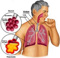 Ca bệnh điển hình về tràn dịch màng phổi tăng bạch cầu ái toan do bệnh ấu trùng giun đầu gai (Eosinophilic pleural effusion in gnathostomiasis)