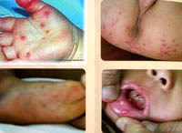 Điểm báo về các thông tin liên quan đến y tế từ ngày 18/2 đến 20/2 năm 2012