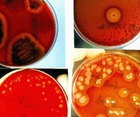 Các khía cạnh bệnh lý cần quan tâm khi chỉ định xét nghiệm ký sinh trùng sốt rét