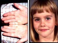 Số ca bệnh tay chân miệng bùng phát tại nhiều tỉnh, thành phố trong các tháng đầu năm 2012