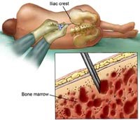 Tủy xương có bị ảnh hưởng do bệnh sốt rét?