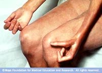 Một số bệnh do ký sinh trùng, côn trùng có tổn thương da và niêm mạc có thể dẫn đến viêm và dày sừng