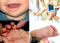 Điểm báo về các thông tin liên quan đến y tế từ ngày 24/5 đến 25/5 năm 2012