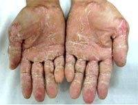 Một số hướng dẫn chẩn đoán và điều trị mới nhất của Bộ Y tế với bệnh lạ, bệnh mới nổi và thử thuốc lâm sàng