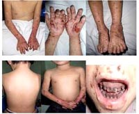 Bệnh lý da hiếm gặp Gunther hay hội chứng congenital erythropoietic porphyria (CEP)