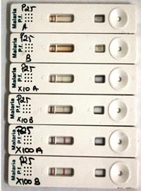 Hiện tượng prozone dễ gây kết quả phản ứng âm tính giả trong xét nghiệm chẩn đoán nhanh bệnh sốt rét