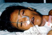 Tổng hợp y văn thế giới nhân ca bệnh sốt rét ác tính do Plasmodium vivax tại tỉnh Bình Định