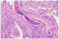 Tổng hợp và cập nhật y văn nhân một trường hợp Hội chứng tăng nhiễm do ấu trùng giun lươn trên bệnh nhân tiểu đường 