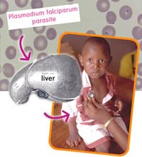 Những thay đổi về hình thái lâm sàng bệnh sốt rét