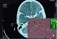 Ký sinh trùng amip ăn não người-Thông tin và những điều cần biết