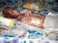 Bệnh hiếm gặp do đa nhiễm ký sinh trùng