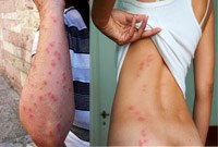 Hậu quả bệnh do côn trùng gây ra