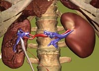 Liên quan giữa chủng loại ký sinh trùng sốt rét với tổn thương thận-tiết niệu trong sốt rét ác tính