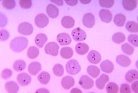 Hồng cầu thay đổi do nhiễm ký sinh trùng sốt rét