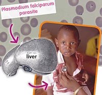 Các thể bệnh sốt rét phân loại theo dịch tễ học và cơ địa