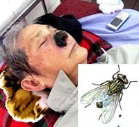 Dòi trong mũi do đâu mà có ?